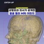 <b>필러</b> 부작용 에반데