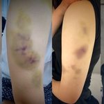 "침대 눕혀 '퍽퍽', 기절해도 때려"… 태권도 코치, 여고생...