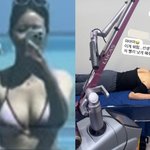 박하나, 심각한 화상 상처..<b>침대</b>에 엎드려 “빨리 낫길” 고통 호소