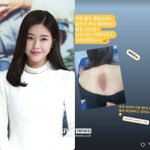 '김태술' 박하나, 충격적 등 상태…<b>화상</b><b>병원</b>行 '날벼락' "낫고 있는...