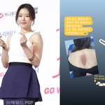 결혼’ 박하나, 아픈 줄도 몰랐는데 날벼락..등 한가운데 <b>선명</b>한...