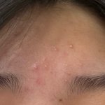 얘들아 이거 <b>모낭염</b>이냐???(혐주의