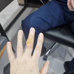 [도와주세요] <b>화상</b>을 입었는데 조언 좀 해주세요.