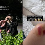 '쌍둥이 임신' 김지혜, <b>낙상</b>사고로 피멍+흉터 가득..최성욱 "아프지...