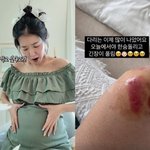 쌍둥이 임신 김지혜, 악몽 같았던 <b>낙상</b> 사고 심각했네…피멍투성이...