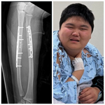 오윤아, 子 <b>민이</b> 팔까지?..“또 부러졌어요” 걱정