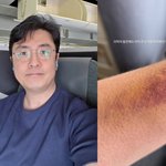 ‘박지윤과 이혼’ 최동석, 시퍼런 주사 멍‥새벽 응급실 흔적 짠하네