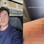 이혼' 최동석, 응급실 실려가…시퍼런 멍 자국까지 [<b>RE</b>:스타]