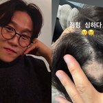 박성광, 심각한 원형탈모 상태‥이솔이 암투병에 맘고생 컸나