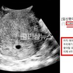 손흥민 협박녀가 '소닉베이비' 닉으로  맘카페에 임신 초음파 사진올리고...