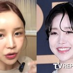 시술 화상' 윤진이, 꼭꼭 감춰뒀던 흉터 공개…얼굴 절반 뒤덮고...