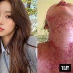 최준희, 염증 가득 루프스병→충격 피부 상태 “<b>나락</b> 딛고 인생 리셋”