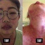 딸' 최준희, 건강 상태 심각했다…"<b>루프</b>스병, 얼굴 무너져"