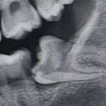 나 <b>사랑니</b> 많이 누운거임??