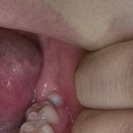 혐주의)<b>사랑니</b> 잘아는사람 있냐