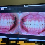 [치아교정전] 치아교정 후 사진 좀 봐주세요