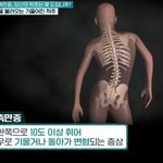 무서운 <b>척추측만증</b>ㄷㄷ