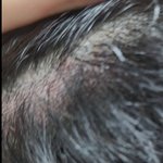 미용실 두피 화상