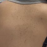 (약혐) 나 등<b>드름</b> 색서침착 흉터 어캄