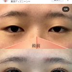 나 <b>쌍수</b> 관심없엇는데 개혹함