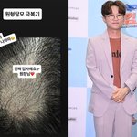 박성광, 천만 <b>탈모인</b>의 희망…"진짜 많이 나와" 원형<b>탈모</b> 극복