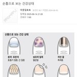 손톱으로 보는 건강상태