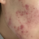 [댓글부탁해] (혐주의) 여드름 피부로 고생하는 사람 정보얻어가