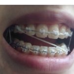 교정 <b>고무줄</b> 진짜 개같다