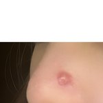 혐주의 <b>코</b> <b>옆</b> 여드름 이거 어케해야됨