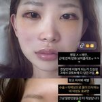 '故 최진실 딸' 최준희, 광대·눈 성형에 흰자까지 부었는데…한...