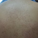 <b>모공각화증</b> 극복기(feat.사진 약혐주의+꿀템 3가지 추천)