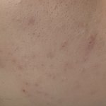 [댓글부탁해] <b>좁쌀</b> 피부 어떻게 해결하나요