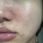 국내에서 제일 효과 좋은 여드름 연고 찾았어(조금 과장) (<b>비포</b>사진o)