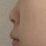 저번에 톡선 코수술 쓰니인데