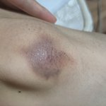 나 <b>무릎</b>에 개큰멍생김