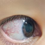 [이것좀봐줘] 눈 <b>핏줄</b> 지나면 없어짐?