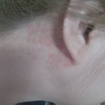 [어떻게해요] 알레르기성 접촉<b>피부염</b>