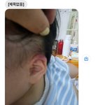 [도와주세요] 어린이집 시간제 보육을 맡겼는데 두개골 골절이 됐습니다...