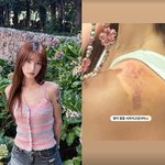 '애셋맘' 율희, 어깨에 시퍼런 '<b>멍자국</b>'…"점점 사라지고 있다"...