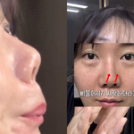 허안나, 코 성형 부작용 "<b>구축</b>+코 비뚤어져"..결국 21년만에...