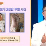 대장암 3기였던 한의사…"죽다 살아나, 대장암 걸릴 행동 했다"...