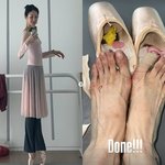 윤혜진, 10발가락에 피멍 투성이 '경악'..<b>발끝</b>으로 선 기술까지