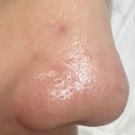 혐주의!!!! 블랙헤드<b>박멸</b>성공함