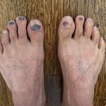 독립유공자 위해 81.5km 뛴 션...<b>만신창</b>이 된 발 사진 뒤늦게...