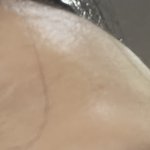 [19] 나처럼 <b>이마</b> 푹 들어간 사람없을듯,,