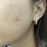 [내과] 와 주근깨 시술 좋구나