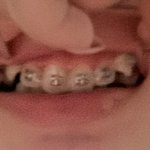 와 나 교정하길 진짜 잘했다