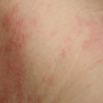 진짜 간지러움이랑 <b>건선</b> 때문에 미칠거 같아