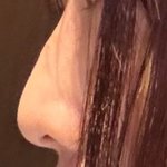 +추가) 나 코<b>수술</b> 했는데 어떰
