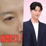  충혈된 새빨간 눈 상태 어쩌나 ('미우새') [<b>Oh</b>!쎈 예고]